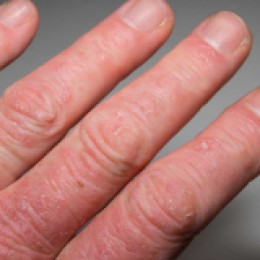 Psoriatic Arthritis