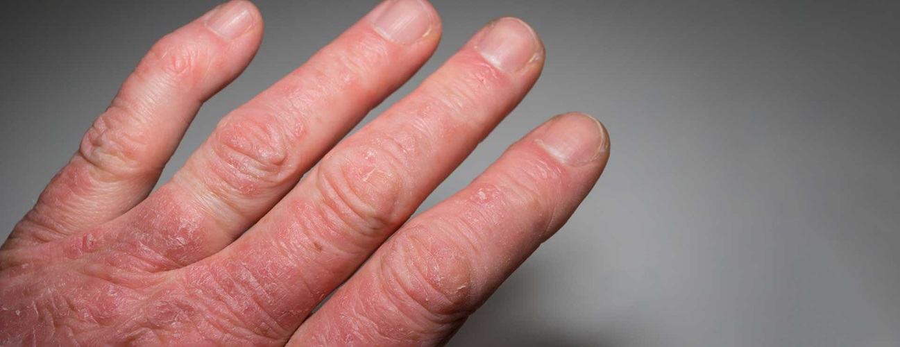 Therapy Interventions For Psoriatic Arthritis Vertis Therapy